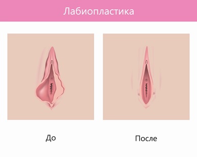 Лабиопластика – пластика половых губ в Нижнем Ногороде