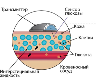 Непрерывный мониторинг глюкозы